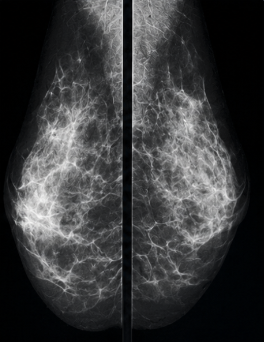 Mammography screening imagery analysed by AI in a DFKI research project.
