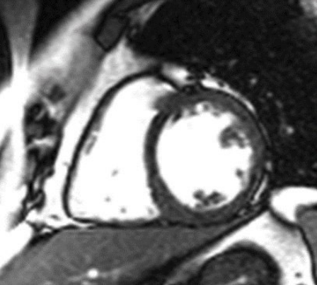 Cardiac MRI moving frame aligned to the reference via deep-learning registration.