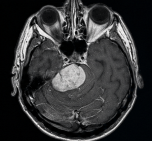 Brain MRI slice with a segmented lesion from a DFKI neuro-imaging project.